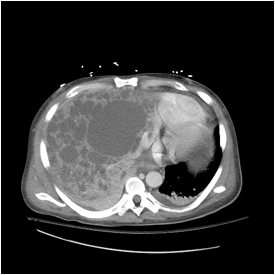 C:\Users\char\Documents\Polycystic Liver\2.jpg