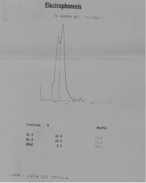 sickle cell electrophoresis