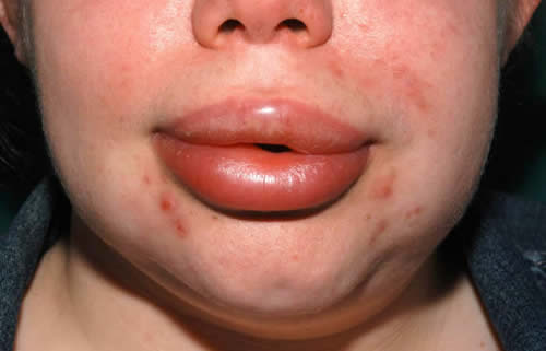 facial angioedema