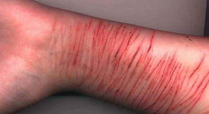 Deliberate self harm (DSH)