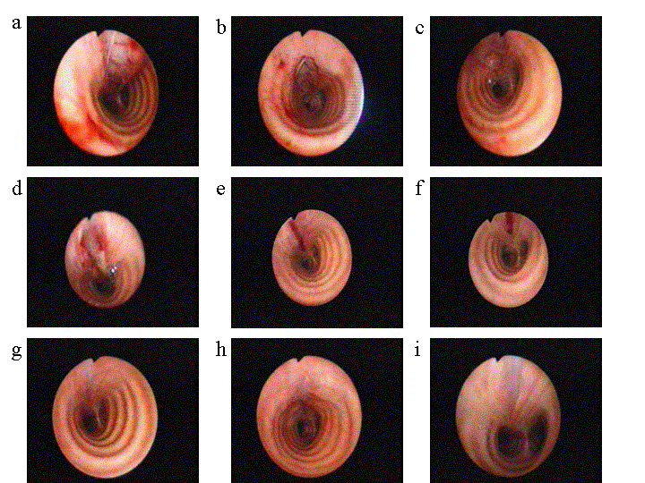 bronchoscope images