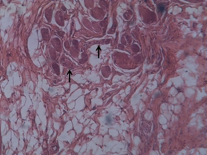 lipoma tongue histology