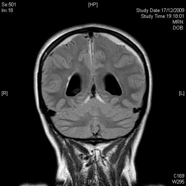 Spontaneous Intracranial Hypotension