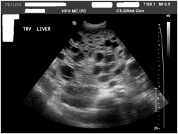 C:\Users\char\Documents\Polycystic Liver\us no name.jpg