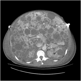 C:\Users\char\Documents\Polycystic Liver\5.jpg