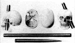 The injuries sustained by Phienas Gage