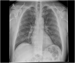 Chest X Ray