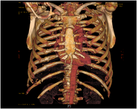 pseudoarthrosis