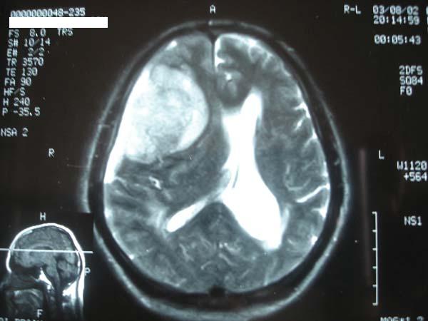 MRI Brain