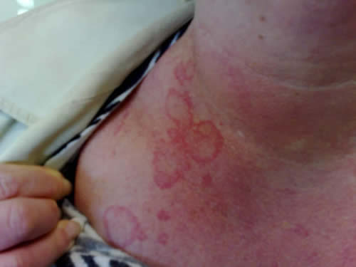 erythema marginatum