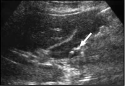 gallstones