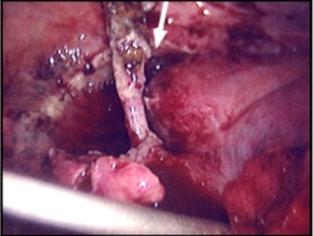 gangrenous appendix