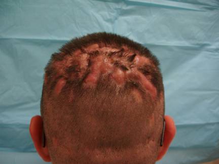 Scalp dissecting cellulitis