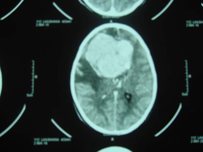 CT of child with apparent ADHD presentation