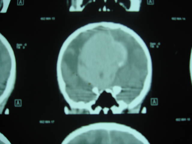 neoplasm in anterior cranial fossa