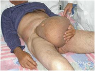 hernia