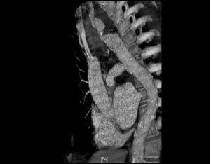 Esophageal carcinoma